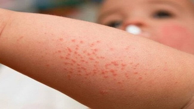 Dấu hiệu sốt xuất huyết ở trẻ em