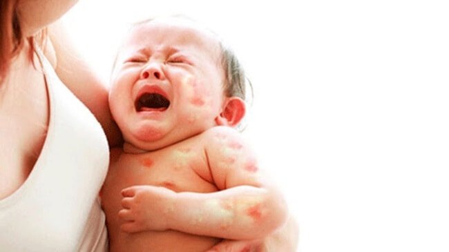 Chăm sóc các bệnh ngoài da ở trẻ