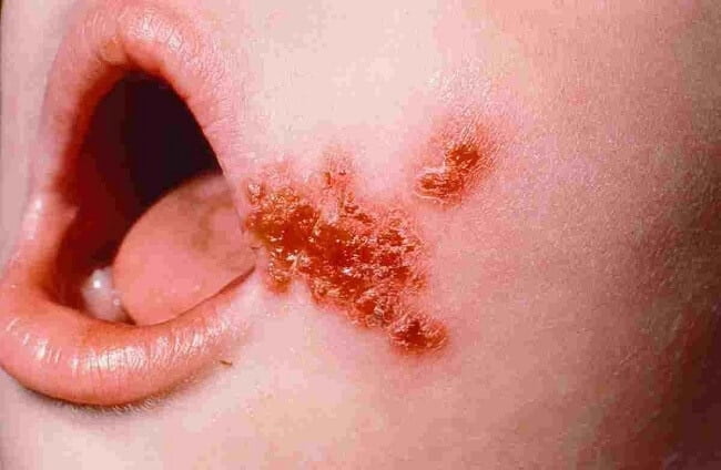 Bé bị chốc lở