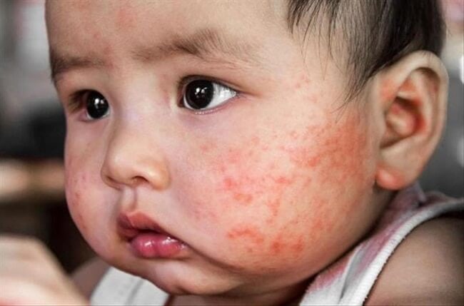 Bé bị chàm sữa