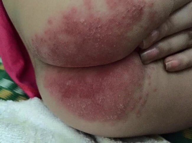 Triệu chứng hăm da của trẻ được chia thành 5 cấp độ