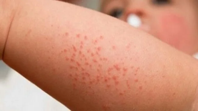 Da bé nổi sần như da gà
