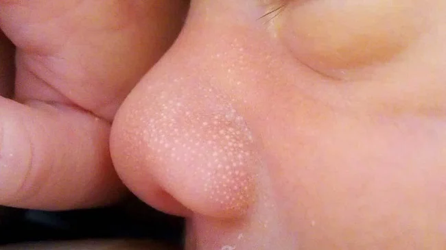Da bé bị đốm trắng