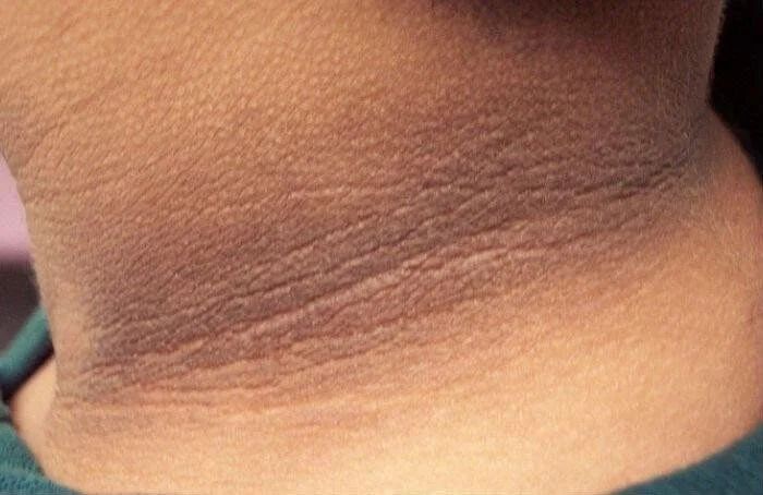 Da bé bị sạm đen