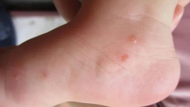 Da bé bị mụn nước