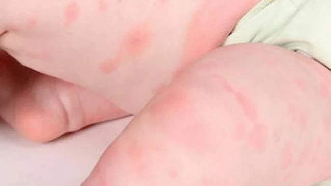 Da bé bị nổi mẩn đỏ