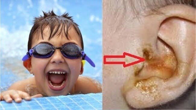 Trẻ bị nhiễm trùng niêm mạc ống tai do dính nước khi tắm hoặc bơi