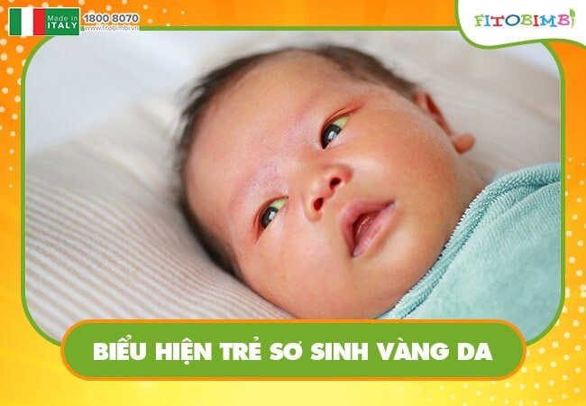 Biểu hiện trẻ sơ sinh vàng da