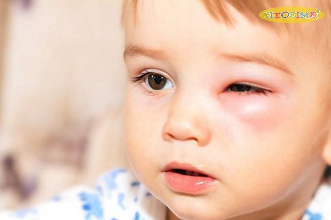 Viêm xoang khiến trẻ khó chịu ở các khu vực mắt, mũi, trán
