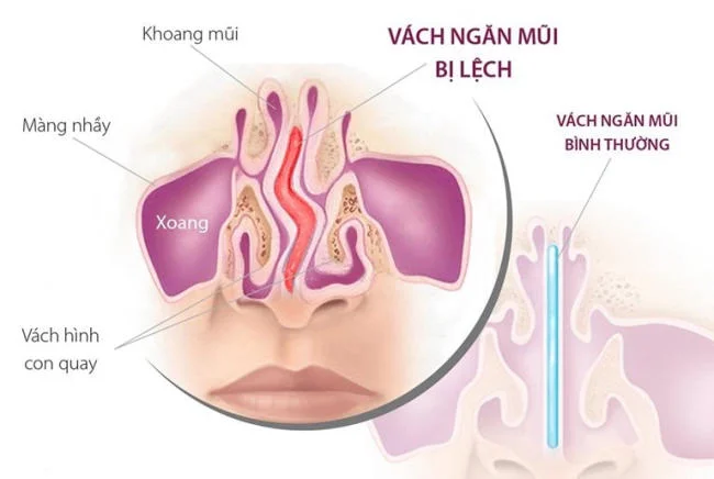 Bệnh viêm xoang ở trẻ nhỏ Bệnh viêm xoang ở trẻ nhỏ