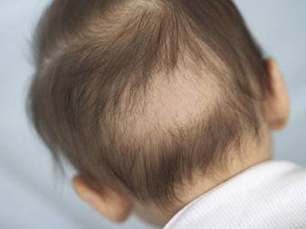 Trẻ thiếu canxi và kẽm thường rụng tóc vành khăn