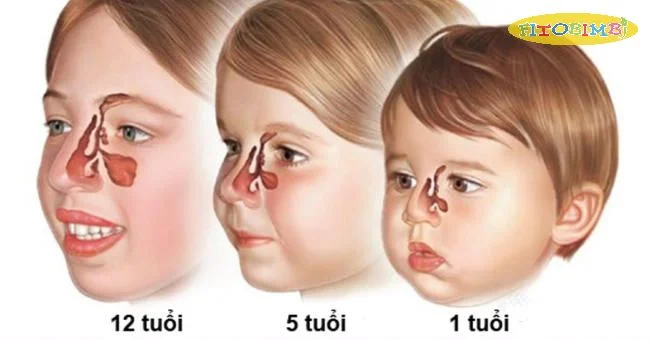 Hệ thống xoang của trẻ nhỏ