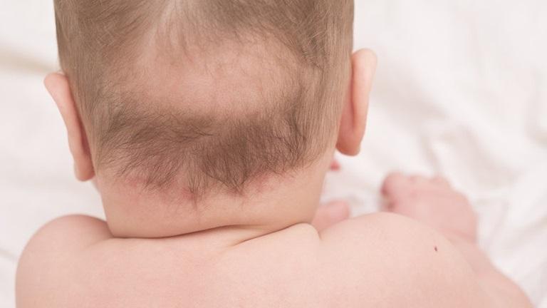 Rụng tóc vành khăn là hiện tượng sinh lý bình thường ở trẻ 3 – 6 tháng tuổi