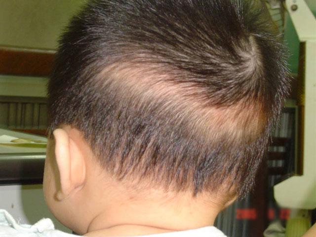 Rụng tóc hình vành khăn ở hiện tượng phổ biến ở rất nhiều trẻ nhỏ
