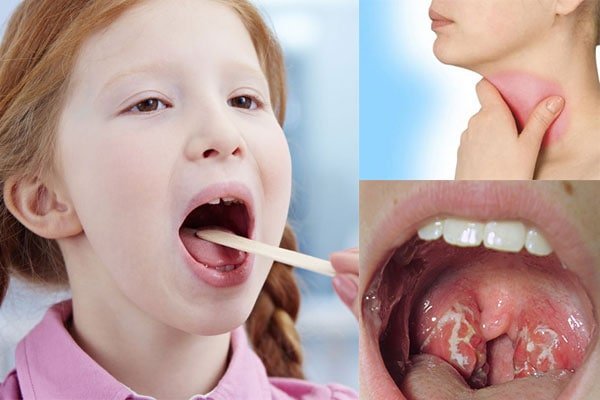 Trẻ dễ bị viêm họng khi thiếu kẽm