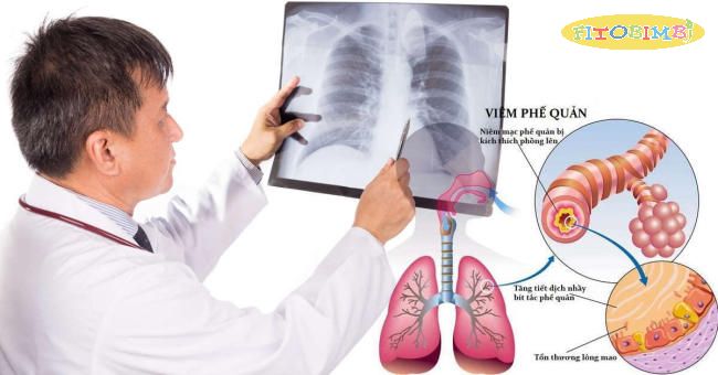 Sự khác biệt giữa viêm phế quản, viêm phổi và cảm lạnh là gì?