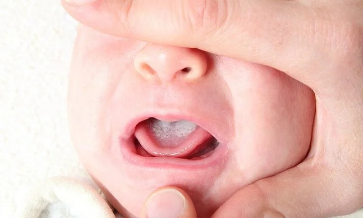 Trẻ bị sưng và đau lưỡi khi thiếu sắt