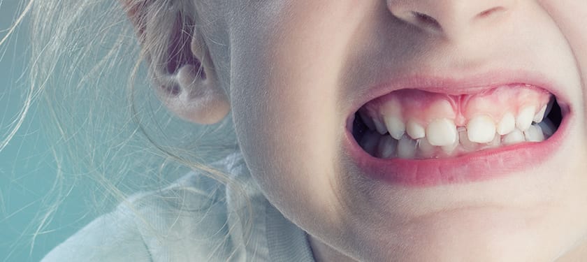 Nghiến răng xảy ra ở mọi độ tuổi trong đó trẻ nhỏ là thường gặp
