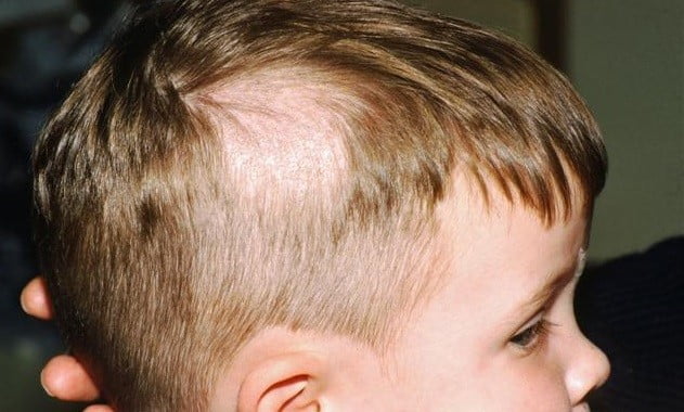 Trẻ nhỏ thường bị rụng tóc theo mảng