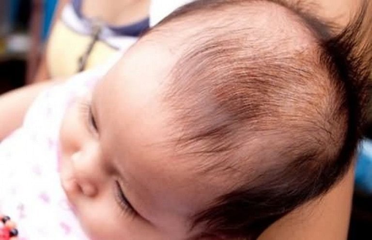 Trẻ bị rụng tóc khi thiếu vi chất kẽm