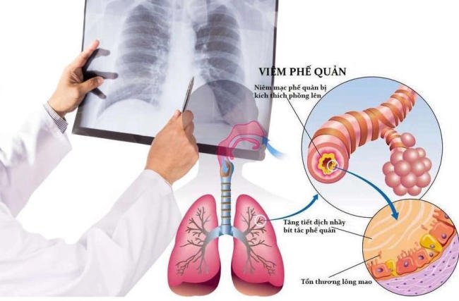 Chẩn đoán viêm phổi dựa trên hình ảnh