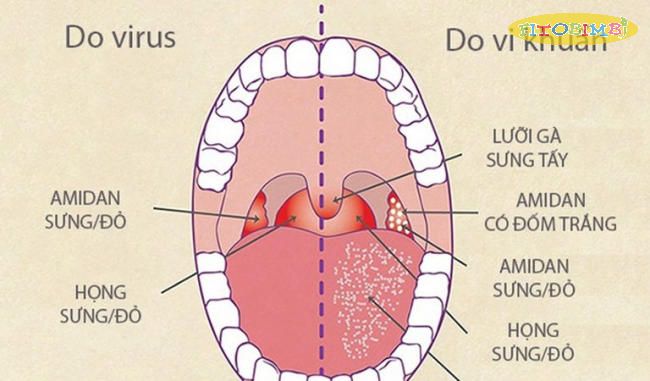 Nguyên nhân trẻ sơ sinh bị viêm họng