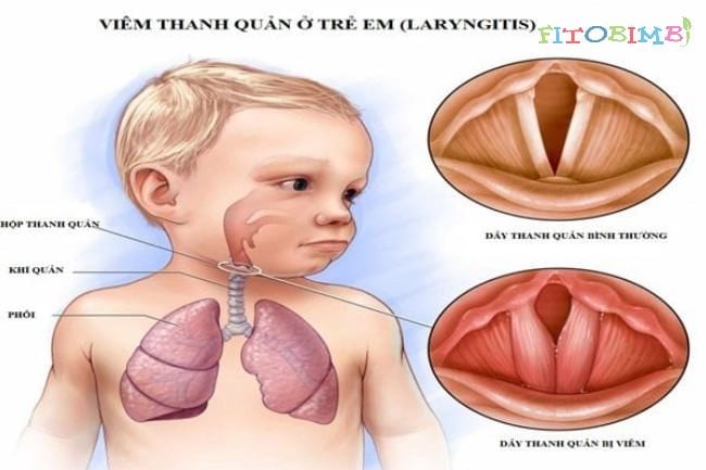 Trẻ bị viêm thanh quản ho sốt về đêm
