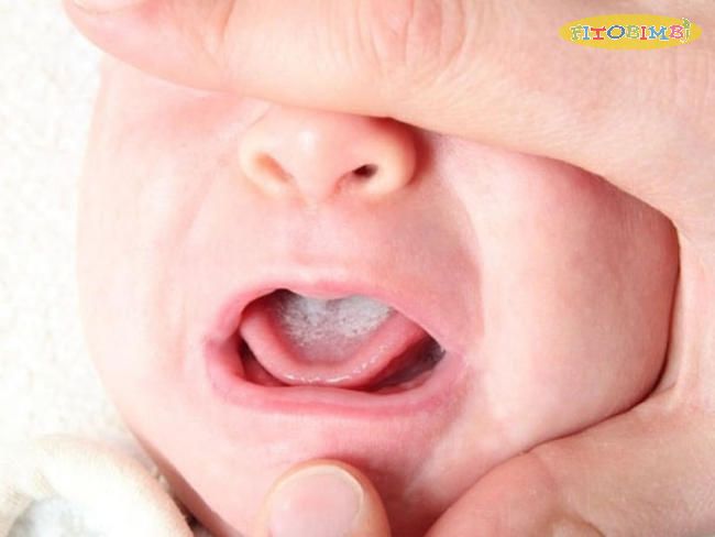 Triệu chứng viêm họng ở trẻ sơ sinh