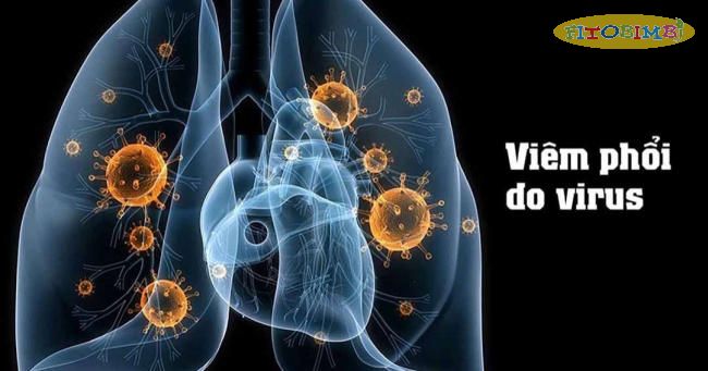 Viêm phổi do virus gây ra