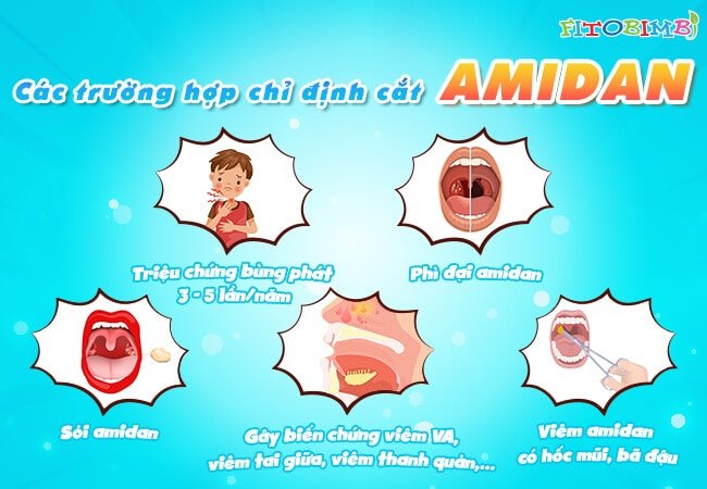 Cắt amidan sẽ được chỉ định trong một số trường hợp