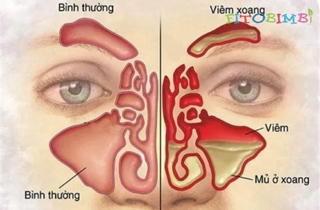 Tìm hiểu về bệnh viêm xoang