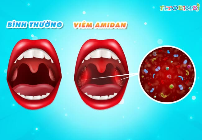 Viêm amidan có thể tự khỏi nếu được phát hiện kịp thời