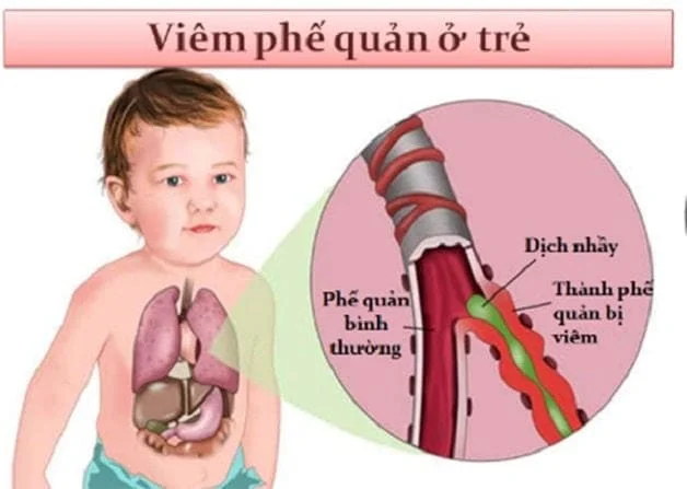 Tìm hiểu về bệnh viêm phế quản ở trẻ em