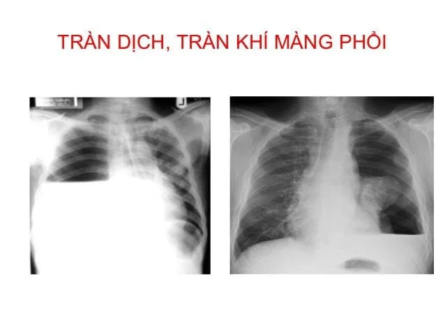 Tràn khí màng phổi gây đe dọa tới tính mạng trẻ
