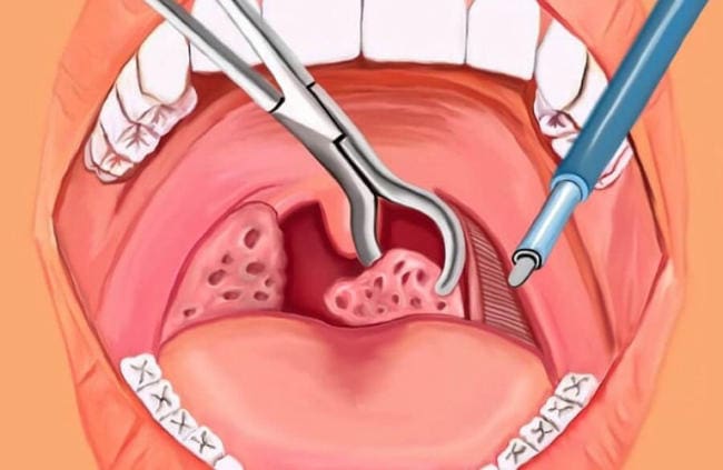 Trẻ từ 4 tuổi trở lên là đối tượng phù hợp để cắt amidan
