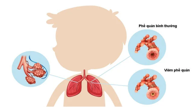 Viêm phế quản gây nguy cơ nhiễm trùng thứ cấp