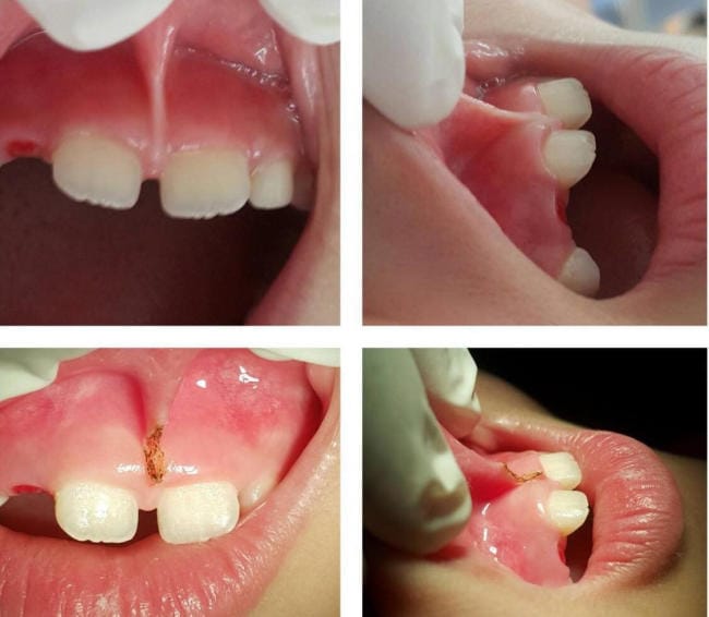 Các bước phẫu thuật dính thắng môi