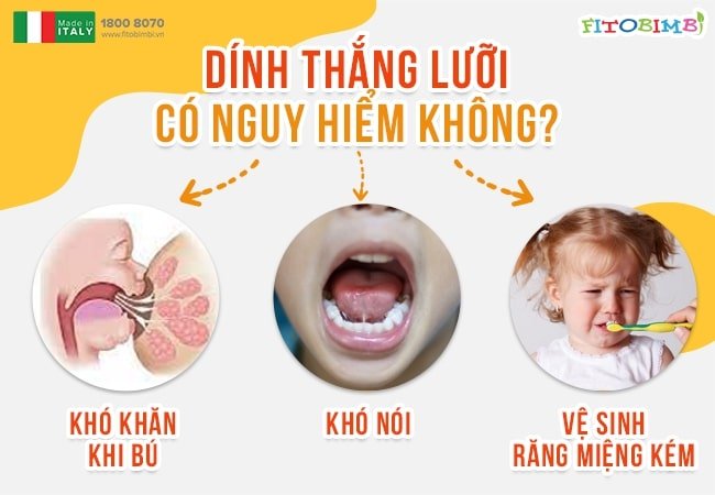 Bị thắng lưỡi khiến bé gặp khó khăn khi bú mẹ