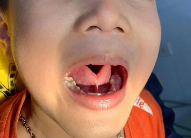 Dính thắng lưỡi khiến bé gặp nhiều khó khăn khi sinh hoạt