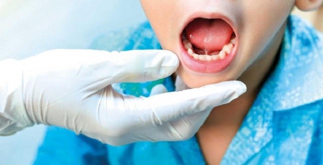 Dính thắng lưỡi là gì? Nguyên nhân, triệu chứng và cách điều trị