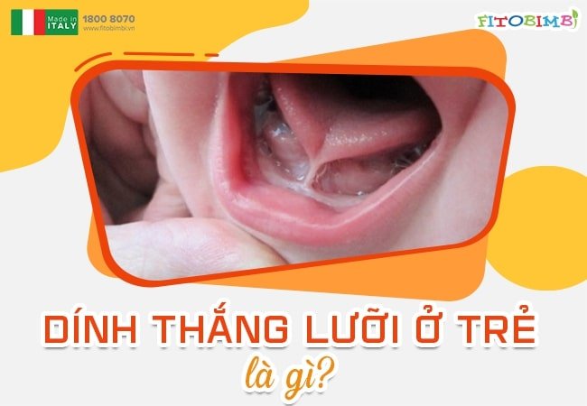 Hình ảnh dính thắng lưỡi ở trẻ