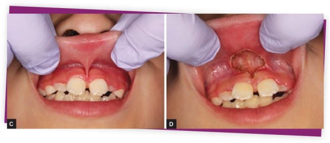 Dính thắng môi trên có thể gây ảnh hưởng rất lớn đến răng miệng