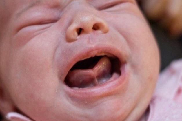 Hình ảnh dính thắng lưỡi ở trẻ sơ sinh
