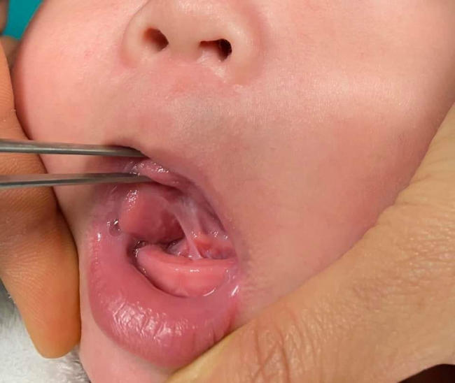 Hình ảnh phẫu thuật dính thắng lưỡi ở trẻ