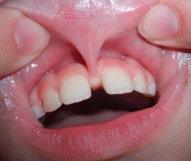 Mức độ 4: thắng môi vượt qua mỏm ổ răng bám vào niêm mạc lợi