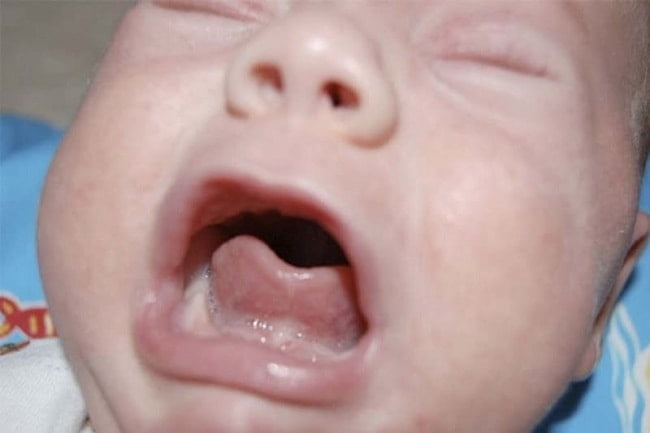 Nếu mức độ dính thắng lưỡi cấp độ 3-4 bé cần phẫu thuật sớm