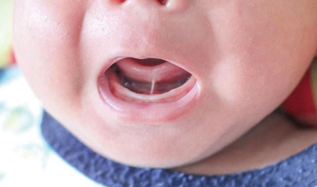 Nhận biết ngay dấu hiệu dính thắng lưỡi ở trẻ và cách điều trị