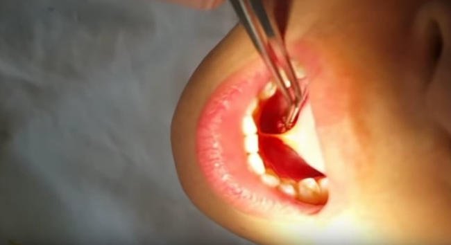 Phẫu thuật cắt bỏ thắng lưỡi cho bé từ sớm