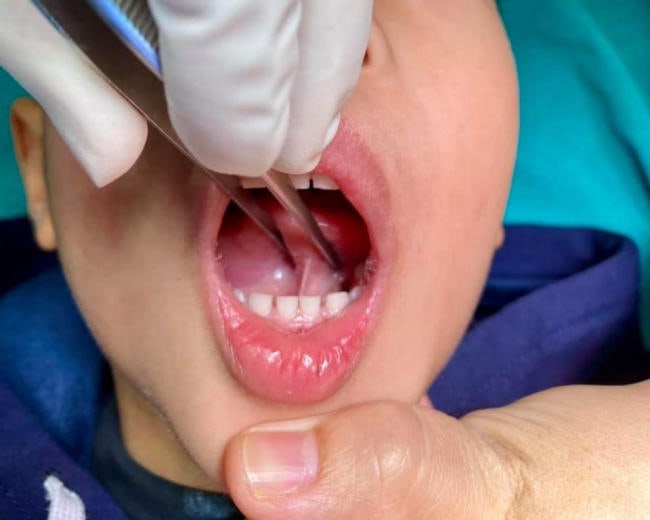 Phẫu thuật dính thắng lưỡi thường không quá nguy hiểm