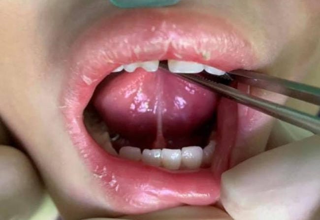 Quá trình phẫu thuật cắt bỏ thắng lưỡi cho bé